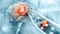 Thumbnail of Ischemic Stroke Treatment: Golden Period of 3 or 8 Hours? Precision Imaging Guides Tailored Therapy