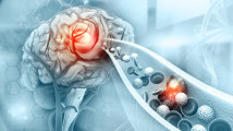 Thumbnail of Ischemic Stroke Treatment: Golden Period of 3 or 8 Hours? Precision Imaging Guides Tailored Therapy