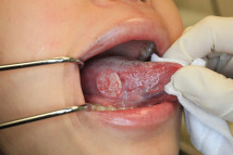 Thumbnail of Early Symptoms of Tongue Cancer are Subtle: Why You Should Get an Oral Examination