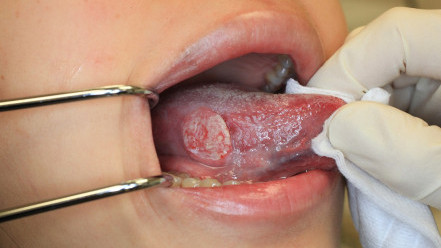 Thumbnail of Early Symptoms of Tongue Cancer are Subtle: Why You Should Get an Oral Examination