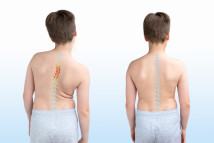 Thumbnail of 3D-Printed Braces: A Lighter, Breathable Solution for Combating Adolescent Scoliosis