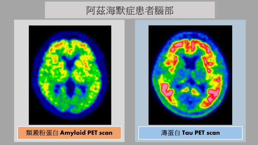 縮圖 - 【阿茲海默症】正電子掃描追蹤大腦雙「元兇」:類澱粉蛋白與濤蛋白 及早診斷把握治療黃金期