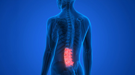 Thumbnail of Understanding Lumbar Spinal Stenosis and Its Treatment