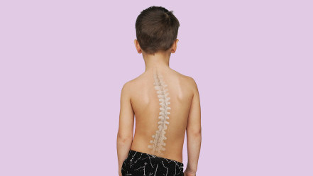 Thumbnail of Surgical and Non-surgical Treatments for Scoliosis