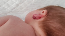 Thumbnail of Infantile Hemangioma: Diagnosis, Treatment and Management