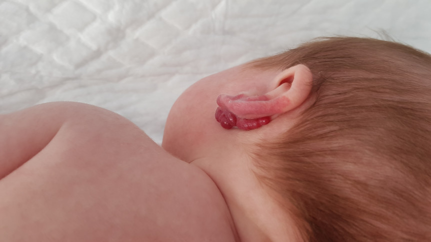 Thumbnail of Infantile Hemangioma: Diagnosis, Treatment and Management