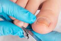 Thumbnail of Ingrown nail, pincer nail and Onychomycosis: Podiatrist's tips of caring your toes nails and choosing shoes