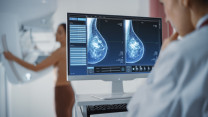 Thumbnail of Silent Stage Zero Breast Cancer and Early detection