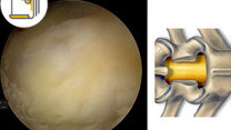 Thumbnail of Treatment of Sciatica