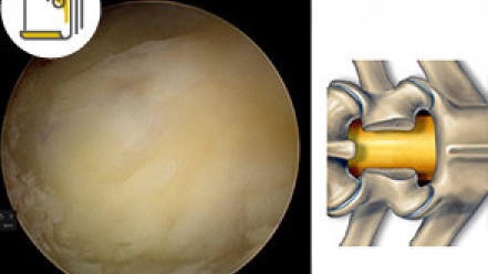 Thumbnail of Treatment of Sciatica