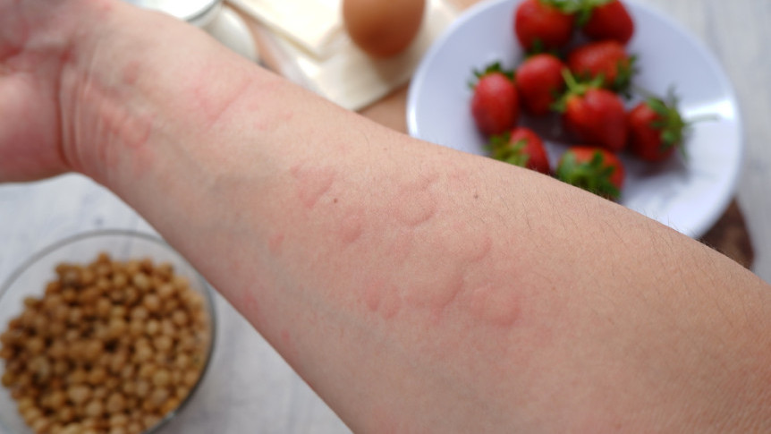 缩图 - 食物过敏：由戒口到预防