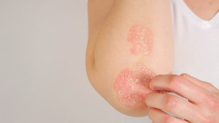 Thumbnail of Eczema during Seasonal Change: 7 Daily Care Tips for Relieving Itchiness and Preventing Deterioration