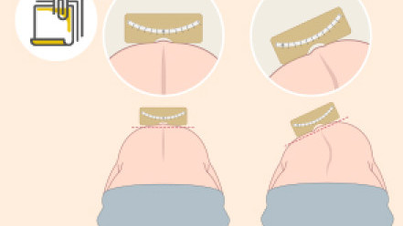 Thumbnail of Early Scoliosis Screening for Children Ensures Effective Treatment