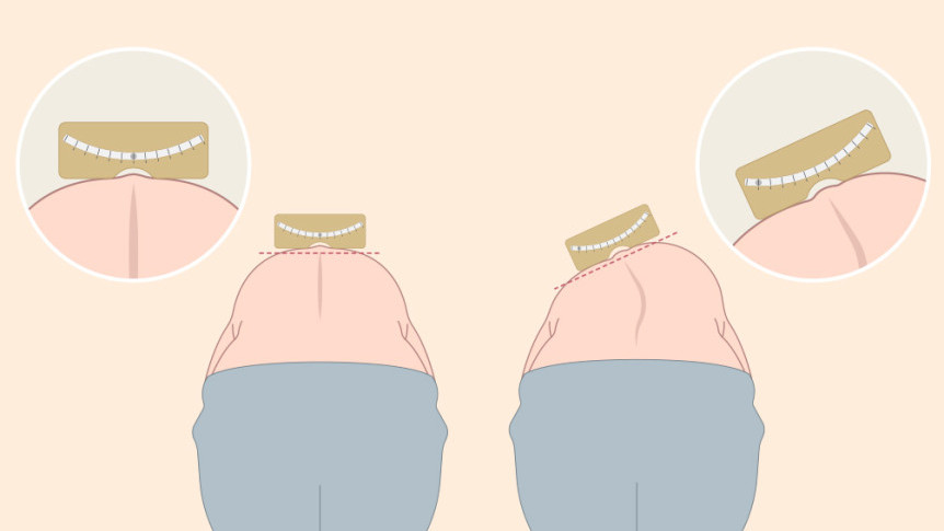Thumbnail of Early Scoliosis Screening for Children Ensures Effective Treatment