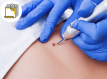 Thumbnail of Warts vs Milia  Do Not Remove Warts by Yourself to Avoid Multiple Growth