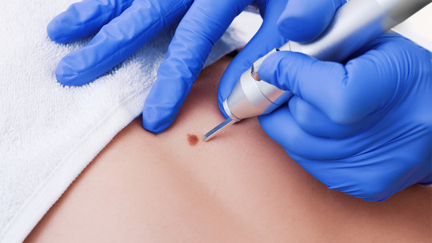 Thumbnail of Warts vs Milia  Do Not Remove Warts by Yourself to Avoid Multiple Growth