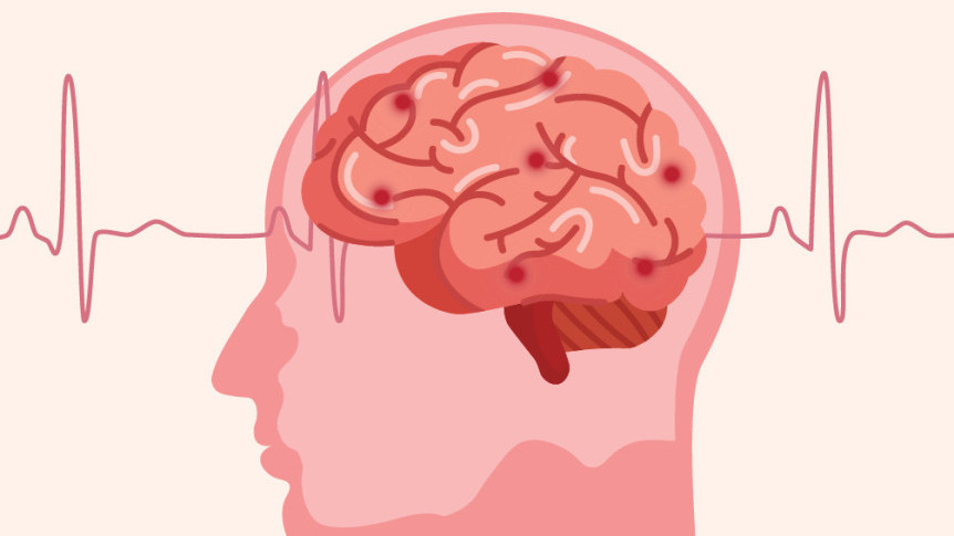 Thumbnail of Stay Alert of Stroke with “FAST”