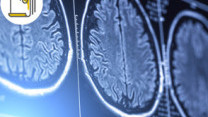 Thumbnail of Hydrocephalus and Traumatic Brain Injury
