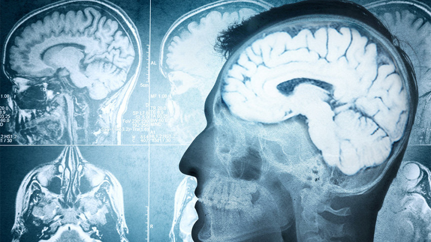 Thumbnail of Relations Between Anticoagulant and Subdural Hemorrhage