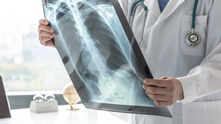 Thumbnail of Risk Factors, Symptoms and Treatment of Lung Cancer