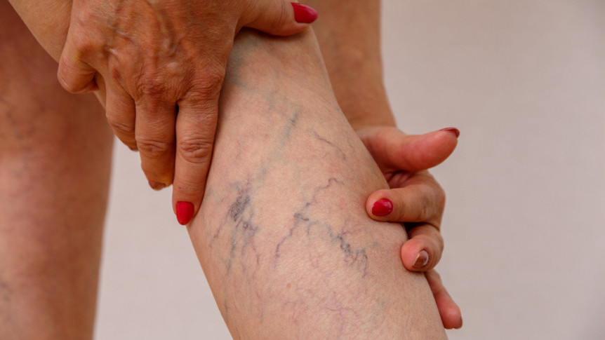 縮圖 - 及早正視   靜脈曲張手尾長