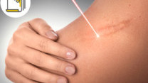 Thumbnail of Radiotherapy in Keloid Treatment