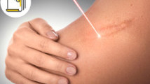 Thumbnail of Radiotherapy in Keloid Treatment