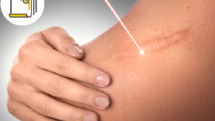 Thumbnail of Radiotherapy in Keloid Treatment