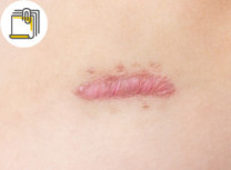 Thumbnail of Dealing with Keloids