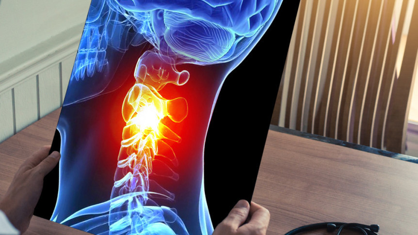 Thumbnail of Effects of Poor Posture on Cervical Spine Injuries