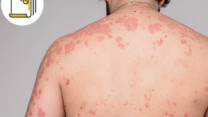 縮圖 - 濕疹vs.蕁麻疹 成因、徵狀、治療不盡相同 找出致敏原 有望跟皮膚敏感說拜拜