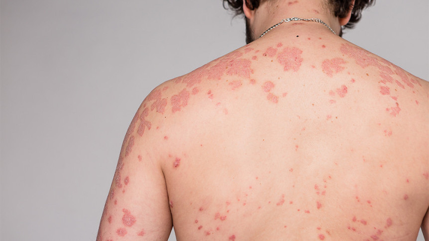 Thumbnail of Eczema vs Urticaria: Causes, Symptoms and Treatment