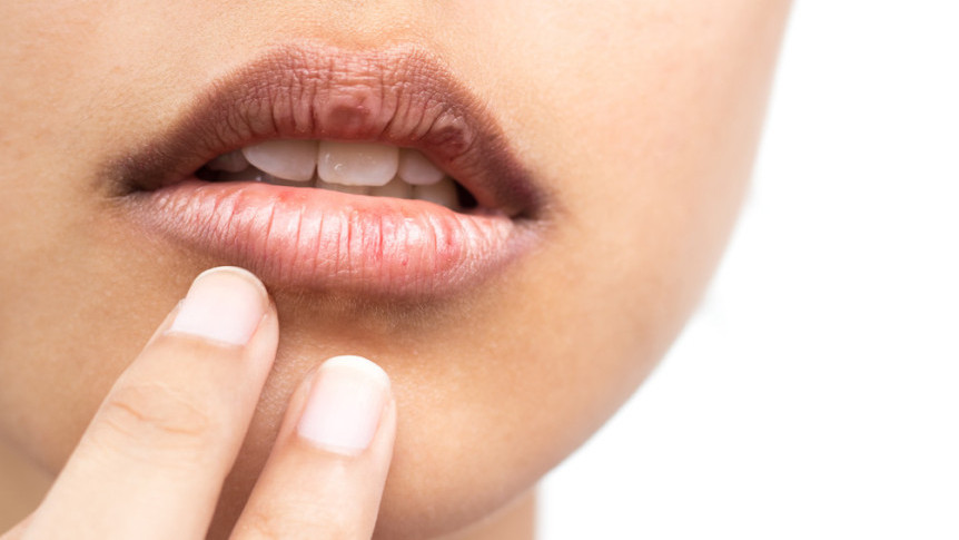 Thumbnail of Causes, Signs and Treatment of Oral Cancer