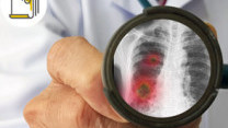 Thumbnail of Possible Causes and Diagnosis of Lung Nodules