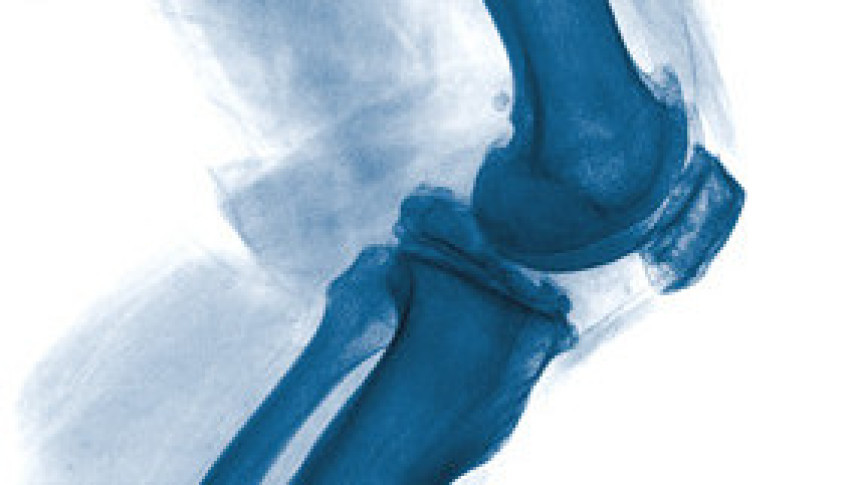 Thumbnail of Robotic-Arm Assisted Knee Replacement Surgery to Treat Osteoarthritis