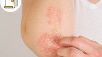 Thumbnail of Treatment Options for Atopic Dermatitis