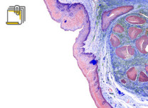 Thumbnail of Lymphoma Staging and Treatment