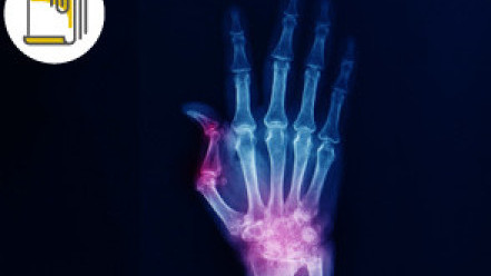 Thumbnail of Rheumatoid Arthritis