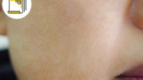 Thumbnail of Seborrhoeic Dermatitis