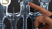 Thumbnail of Common Cancer in Men - Throat Cancer