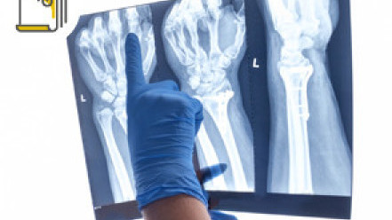 Thumbnail of De Quervain's Tenosynovitis