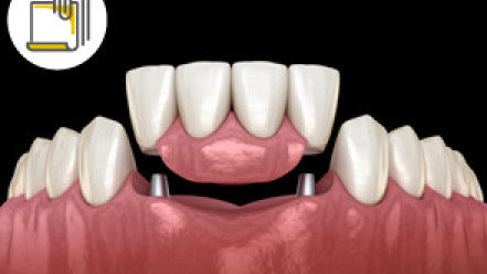 Thumbnail of Root Canal Therapy