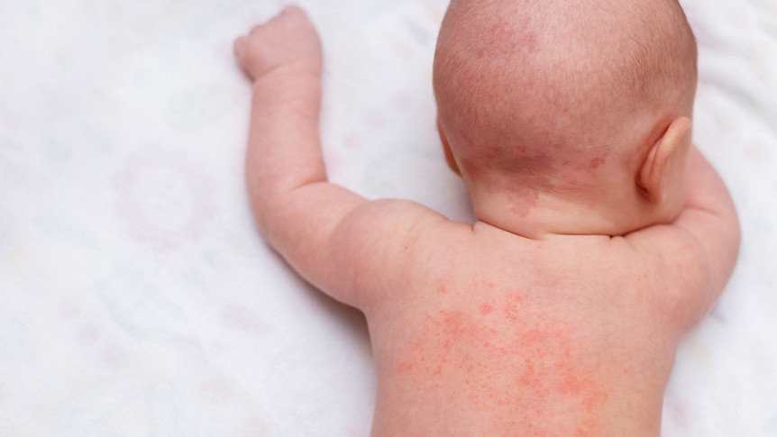 Thumbnail of Eczema