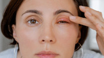 Thumbnail of Eyelid Conditions: Dry, Stinging Eyes? Drooping or Turned Eyelids Could Be the Cause — 2 Protection Tips