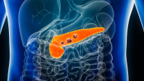 Thumbnail of Precision Radiotherapy for Pancreatic Cancer: MR-guided, Stereotactic Body Radiotherapy (SBRT), and Real-Time Tracking (Chinese Only)