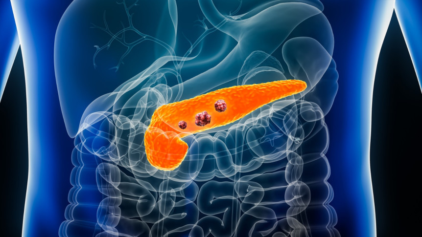 Precision Radiotherapy for Pancreatic Cancer: MR-guided, Stereotactic Body Radiotherapy (SBRT), and Real-Time Tracking