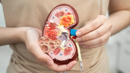 Thumbnail of Polycystic Kidney Disease: Big Cysts Can Cause Kidney Failure — Over 80% Are Inherited