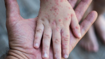 Thumbnail of Protect Kids from Measles: Spot Early Symptoms and High-Risk Groups