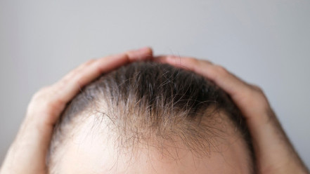 Thumbnail of Hair Loss Treatment: Half of Men, One-Third of Women Over 50 Face Hair Loss — Hair Growth Lotion Is First-Line