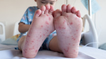 Thumbnail of Hand, Foot and Mouth Disease: Peak Season Until July – Fever, Rashes, Mouth Ulcers – 3 Hygiene Tips to Stay Safe